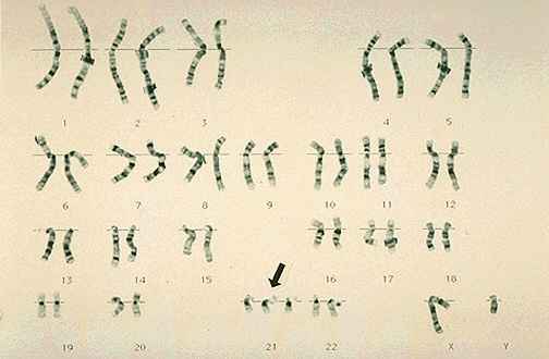Chromosomes of a boy with Down Syndrome